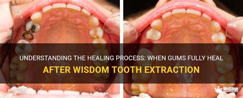 Understanding The Healing Process When Gums Fully Heal After Wisdom