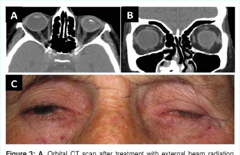 Figure 3 From Case Radiation Therapy For Eyelid Basal Cell Carcinoma