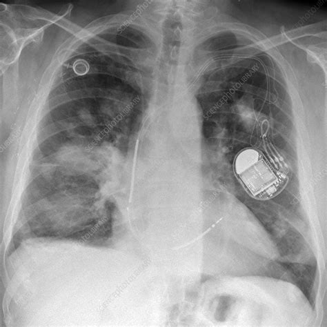 Secondary Lung Cancer X Ray Stock Image C0473410 Science Photo Library