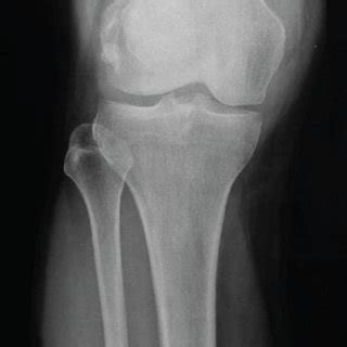 Radiographic Imaging Of The Right Knee In Anteroposterior A Lateral