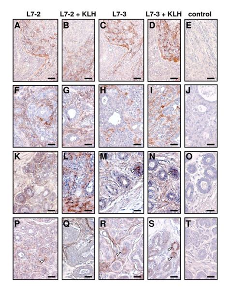 Immunohistochemistry Of Primary Breast Tumors From Four Different