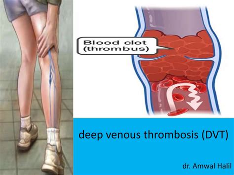 Aw Tugas Ppt Dvt Diagnosis Dan Tatalaksananyapptx