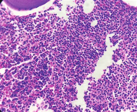 Bone Marrow Biopsy Showing Hypercellular Marrow With Diffuse