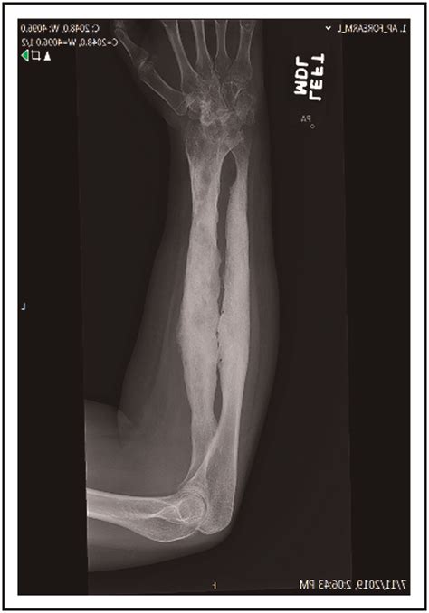 Forearm X Ray Showing Bone Expansion Sclerosis And Cortical Thickening