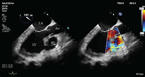 Transesophageal Echocardiogram Midesophageal 3 Chamber View Taken Download Scientific Diagram