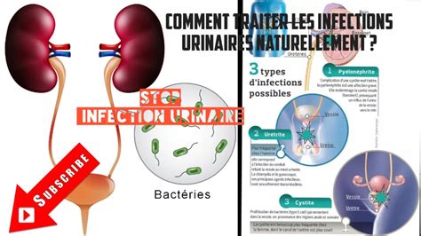 infections urinaires symptômes DrBeckmann