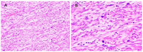 Histological Appearance Of Mpnst Hematoxylin Eosin Staining For Mpnst Download Scientific