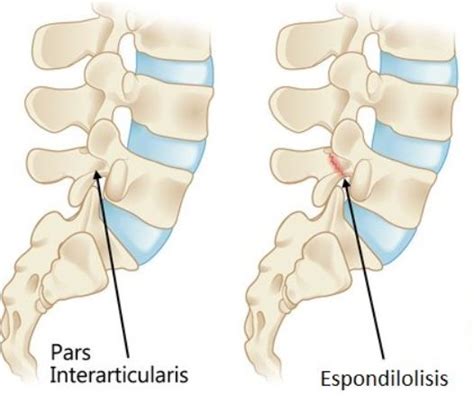 Espondilolistesis Degenerativa Espondilolisis Traumatologia I