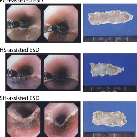 Constriction Of Esophagus By Endoscopic Submucosal Dissection Esd Download Scientific Diagram