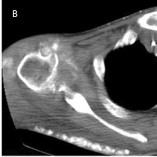 A 28-year-old male patient who underwent an MRI of the elbow joint and ...