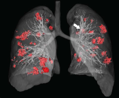 Imaging In A Year Old Man Who Presented With Fever And Cough For