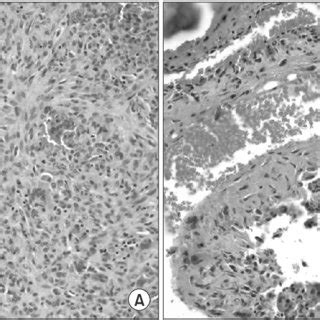 A Photomicrograph Of Curetted Lesions Shows The Presence Of