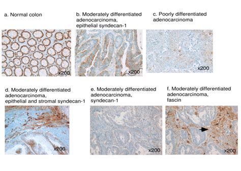 Expression Of Syndecan 1 In Normal Colonic Epithelium And Colon