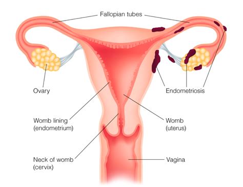 Endometriosi Sintomi Cause Diagnosi E Cura