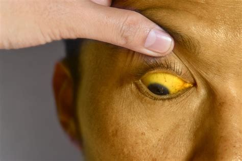 Jaundice Treatment In Ayurveda