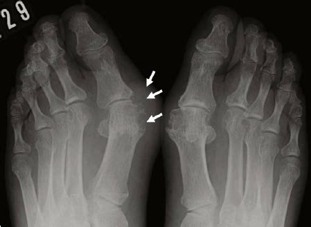 Tophaceous gout: X-ray shows soft tissue swelling, tophus and... | Download Scientific Diagram