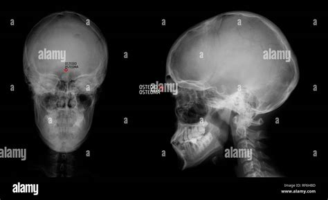 コンプリート！ paranasal sinuses x ray labeled 481856-Paranasal sinuses x ray anatomy