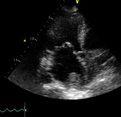 Echovar Eco Del Dia La Estenosis Mitral Revisi N Del Jase Julio