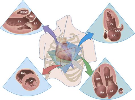 Normal Anatomy And Flow Patterns On Transthoracic Echocardiography Thoracic Key