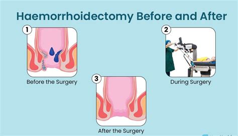 LASER FISSURECTOMY For Anal Fissures