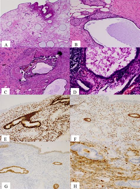 A Case Of Ureteric Polypoid Endometriosis Presenting In A Post