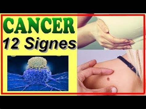 12 SIGNES ou SYMPTÔMES Précurseurs du CANCER Signaux dalerte