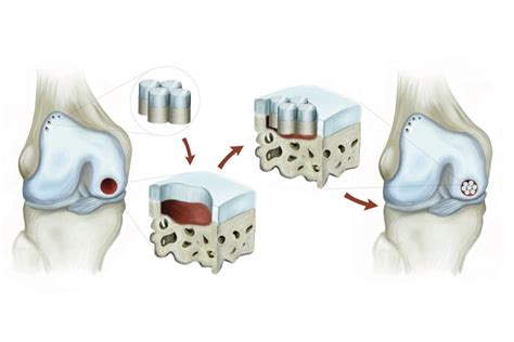 Cartilage Restoration Transplantation Rockwall Tx Manoj Reddy