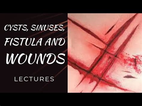 CYSTS SINUSES FISTULA WOUNDS Lecture 4 WOUNDS Classification Healing