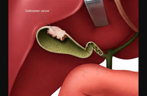 Mayo Clinic Gallbladder Polyps Cancer Diagnosis Doctors Without