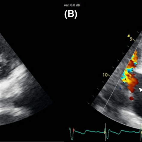 Transthoracic Echocardiogram Demonstrating Ventricular Septal Aneurysm