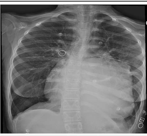 Figure 2 From The Role Of Cardiovascular Surgery In The Management Of A