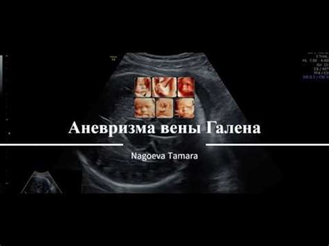 Аневризма вены Галена - YouTube