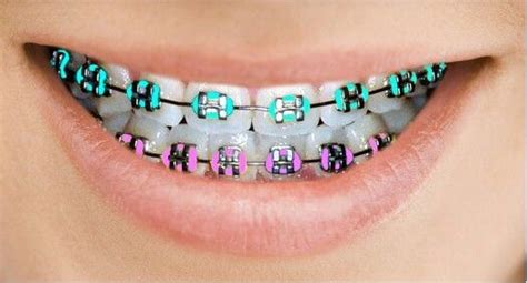 Choose The Braces Colors E1481565606281jpeg Braces Explained