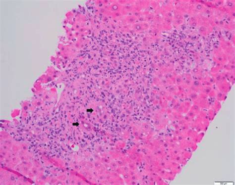 Liver Tissue With Features Of Graft Versus Host Disease Histologic