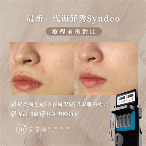 Hydrafacial海菲秀｜水飛梭｜ 享艾美時尚診所 Imbest