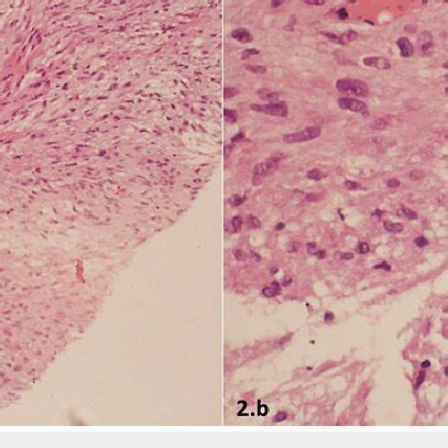 colonoscopic findings  colon cancer   large fungating mass
