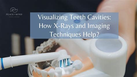 Visualizing Teeth Cavities: How X-Rays and Imaging Techniques Help ...