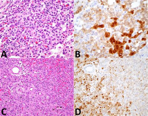 Comparative Molecular Analysis Of Testicular Leydig Cell Tumors