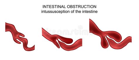 Intussusception De Lintestin Illustration De Vecteur Illustration Du