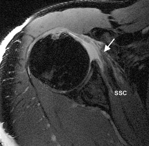 Mr Imaging Of Rotator Cuff Injury What The Clinician Needs To Know