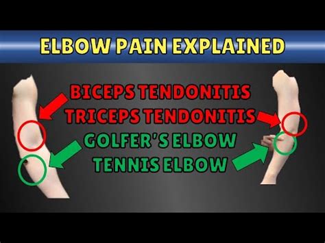 Explaining Tennis Elbow Vs Golfer S Elbow Vs Triceps Tendonitis Vs