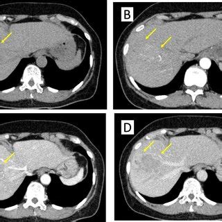 Preoperative Dynamic Enhanced Computed Tomography A Plain Image B