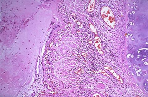 Pathology Outlines Asthma