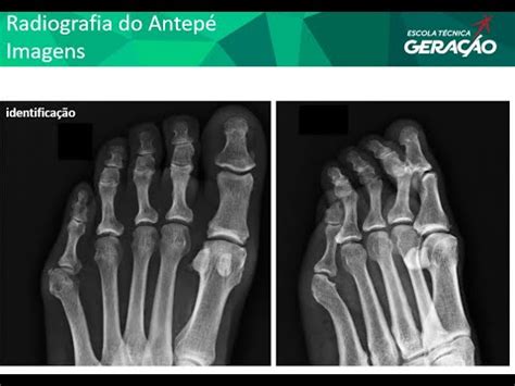 Radiografia Do Antep Ap Obliqua Youtube