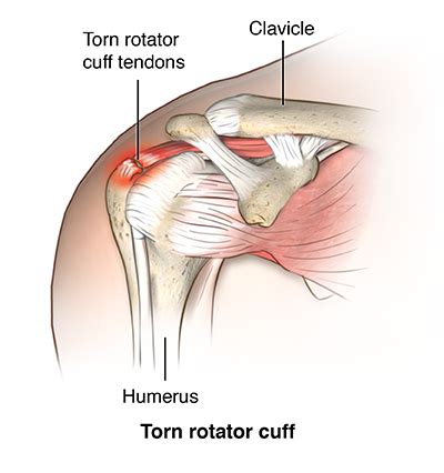 Rotator Cuff Tears Xcell Medical Group Elyria Ohio