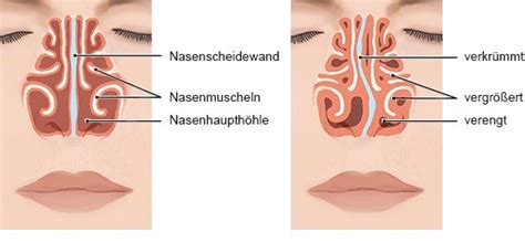 Sinusitis Op Wie Lange Krank Hotsell Pacificproductsandservices