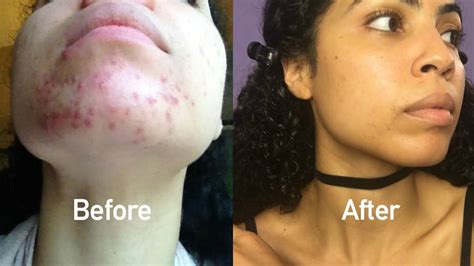 How I Naturally Cured My Cystic Acne Youtube