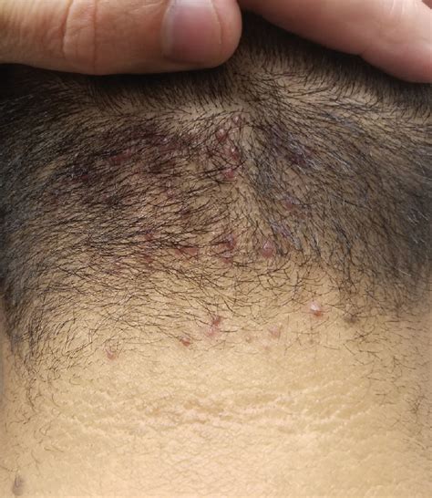 Hair Bumps On Back Of Neck