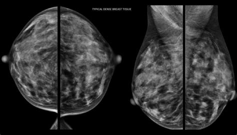 Breast Imaging Market In 2020 Size Projection With Top