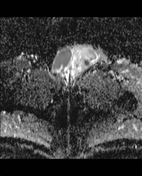 Testicular Seminoma Image